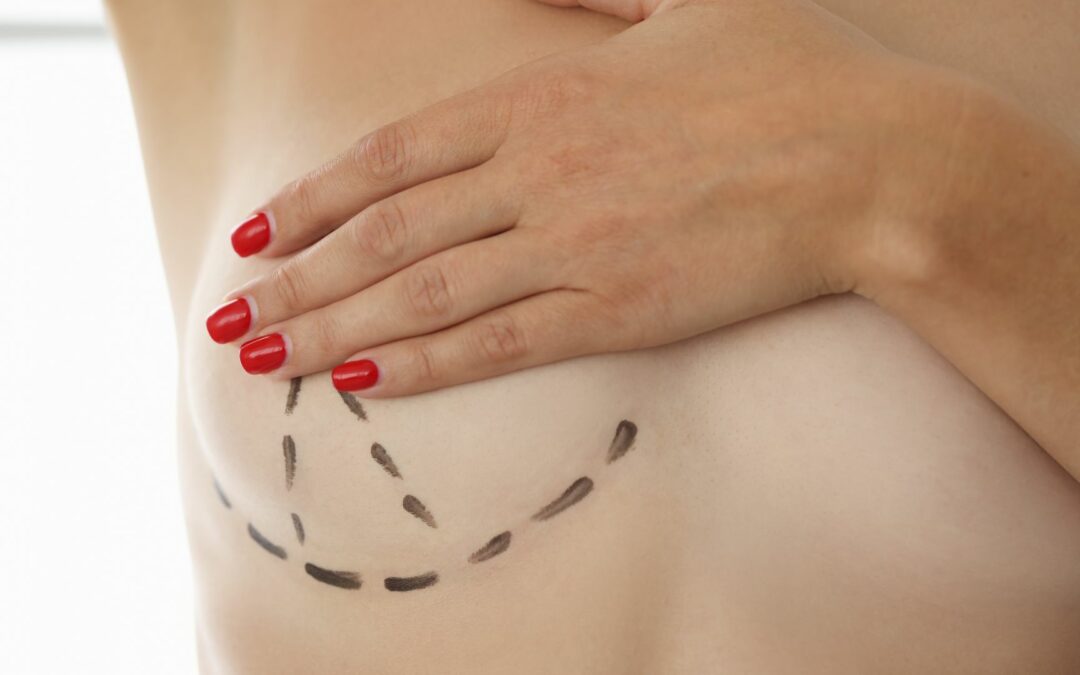 Ce que pensent les patientes du lipofilling mammaire