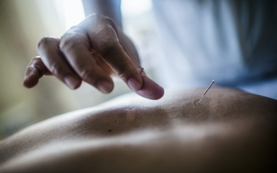 L’acupuncture : une ancienne technique de relaxation revisitée