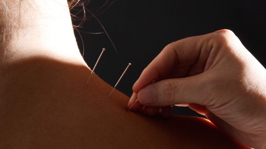aiguille acupuncture