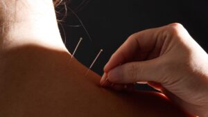 aiguille acupuncture