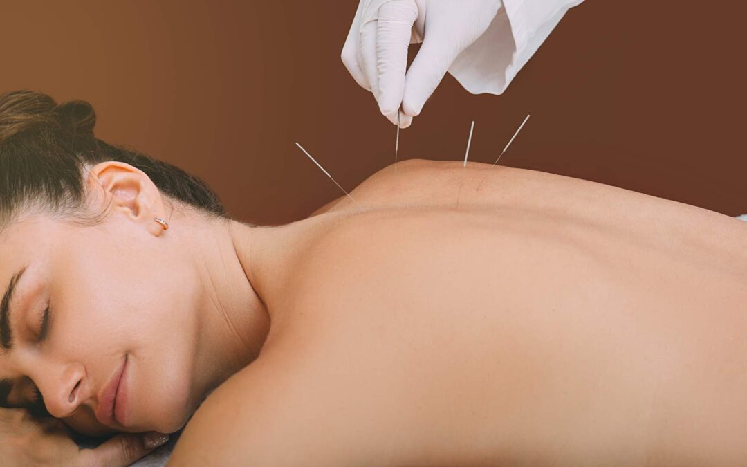 10 bienfaits de l’acupuncture pour votre santé générale
