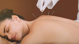 Aiguille acupuncture