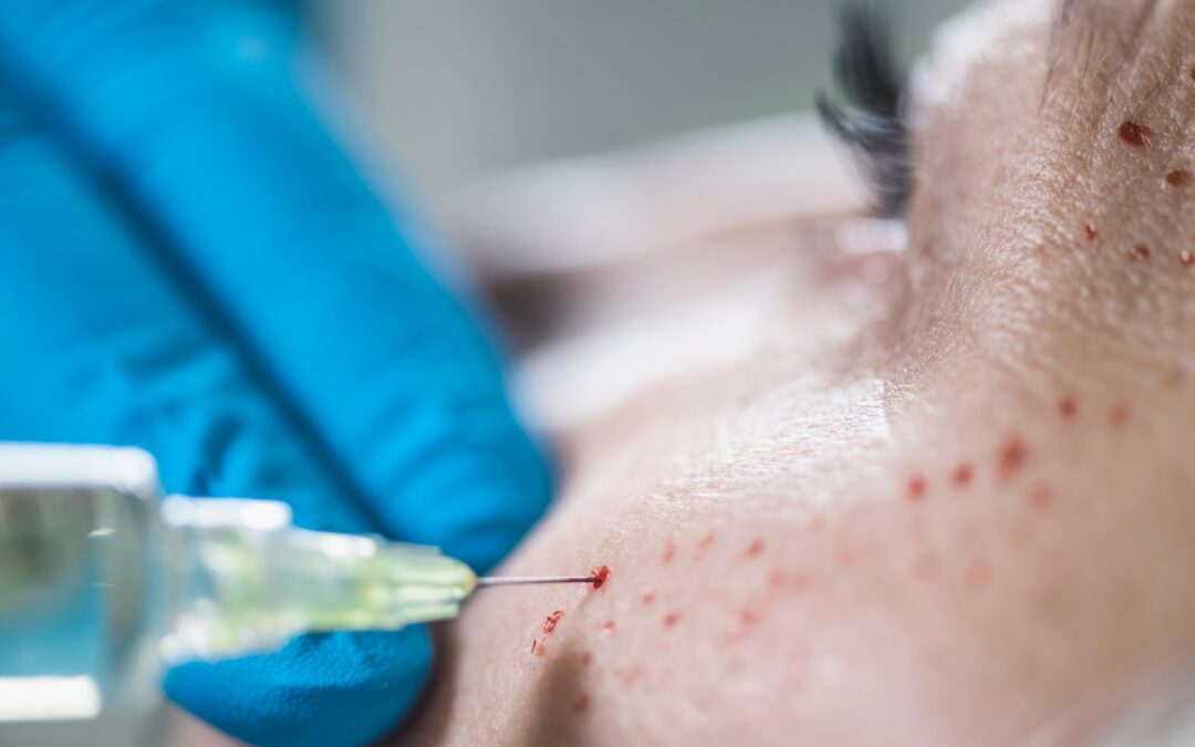 De la peur de l’aiguille au sourire post-injection : comment surmonter ses appréhensions ?