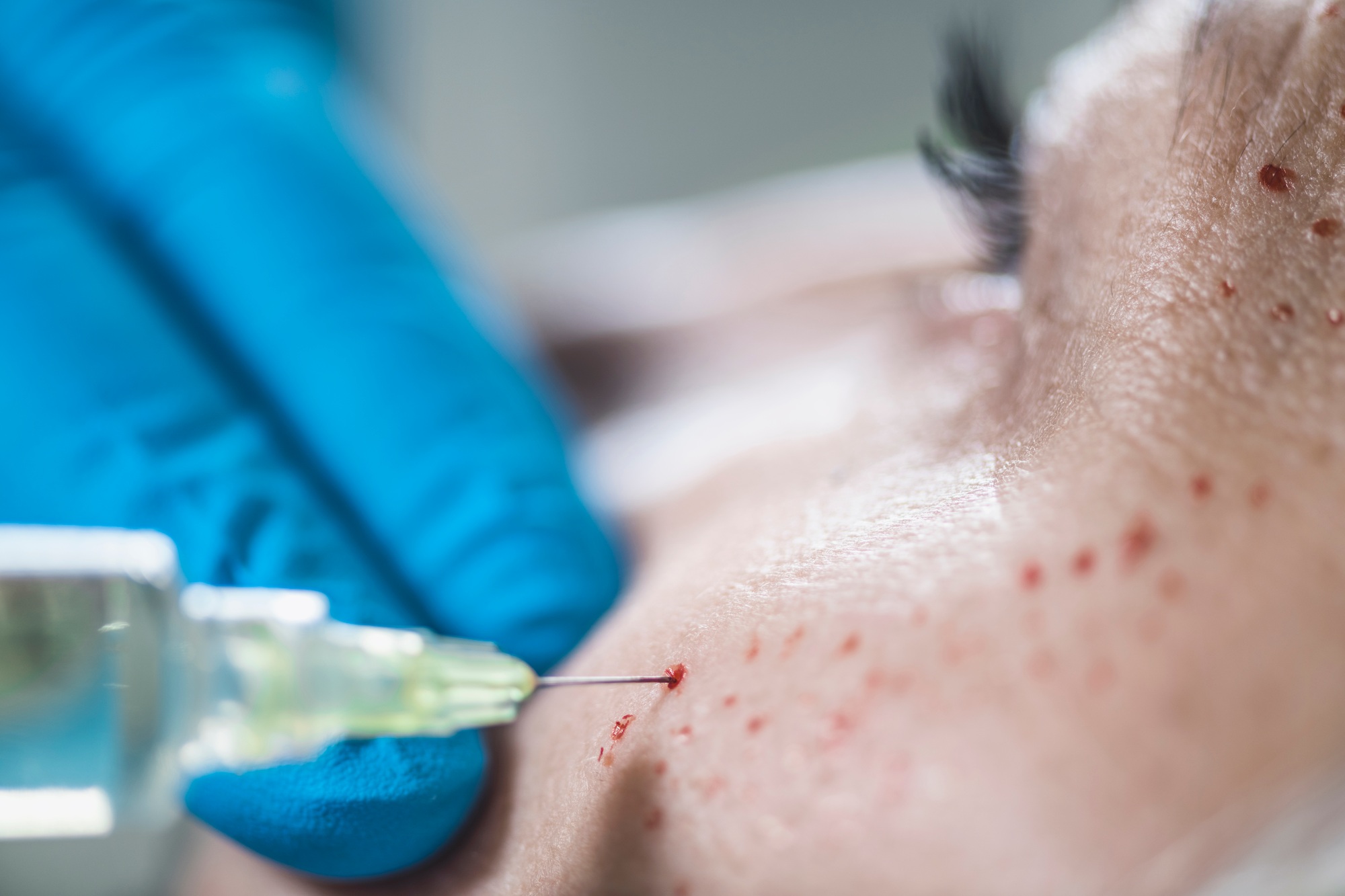 PRP Face Cosmetics Injecting. Cosmetic Anti-Aging Face Treatment