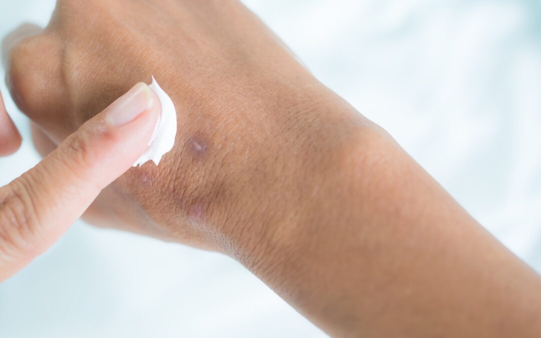 Pourquoi utiliser une crème cicatrisante ?