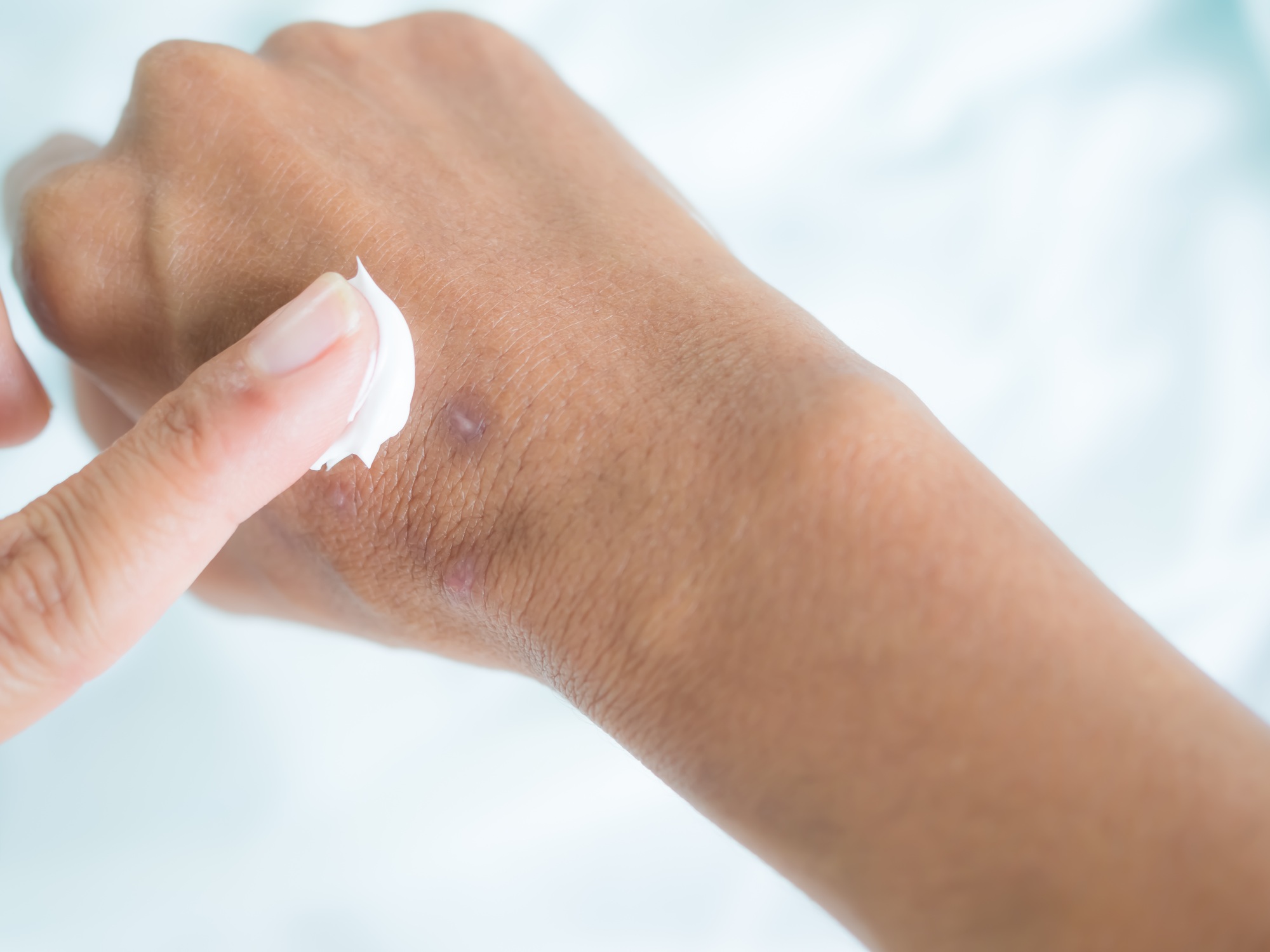 Scar on hand woman. finger applying removal blister wound on skin body